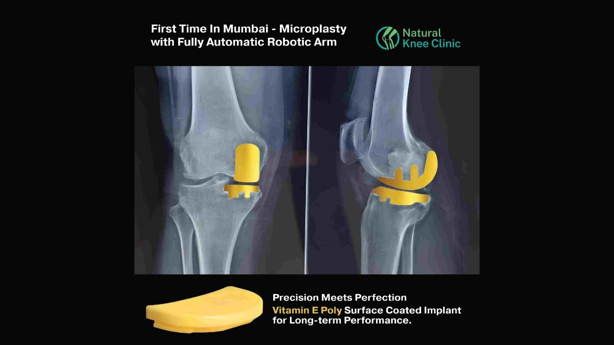 Medical Breakthrough: Preserve Your Natural Knee with Absolute Precision Robotic Microplasty Surgical Technique